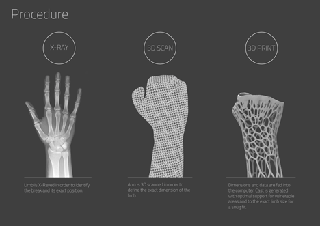 Cortex 3D-printed cast for fractured bones by Jake Evill