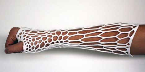 Cortex 3D-printed cast for fractured bones by Jake Evill