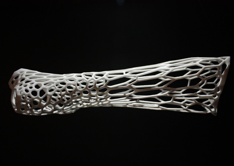 Cortex 3D-printed cast for fractured bones by Jake Evill