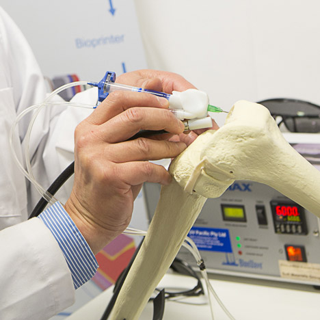 3D-printing BioPen “draws” with living cells to repair damaged bones