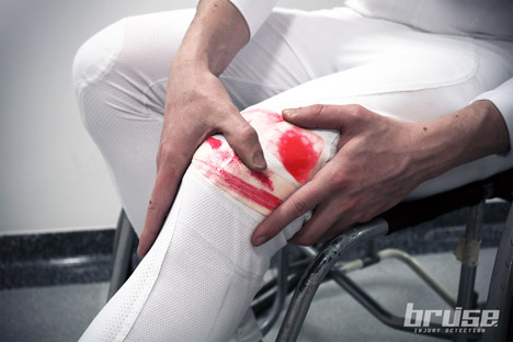 Bruise for sporting injuries by RCA students
