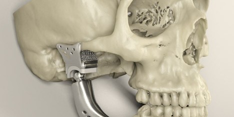 Custom-fit 3D-printed medical implant for bone reconstruction by Sebastiaan Deviaene