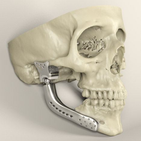 Custom-fit 3D-printed medical implant for bone reconstruction by Sebastiaan Deviaene