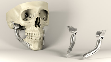 Custom-fit 3D-printed medical implant for bone reconstruction by Sebastiaan Deviaene