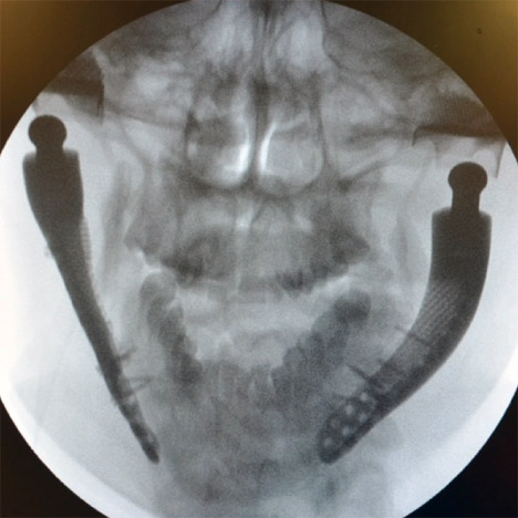 Custom-fit 3D-printed medical implant for bone reconstruction by Sebastiaan Deviaene