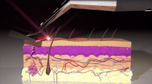 Skarp laser razor