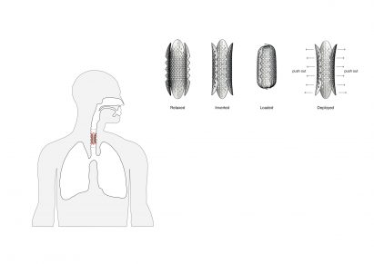 Tonkin Liu shrink their architectural shell lace structure for prototype windpipe stent