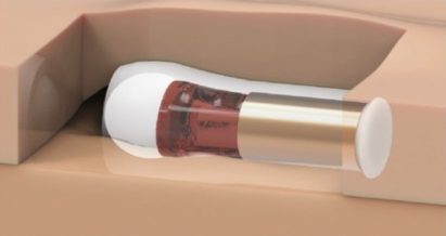 The Wearable Opioid Antidote Device