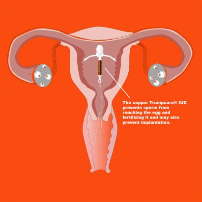 Trumpcare IUD